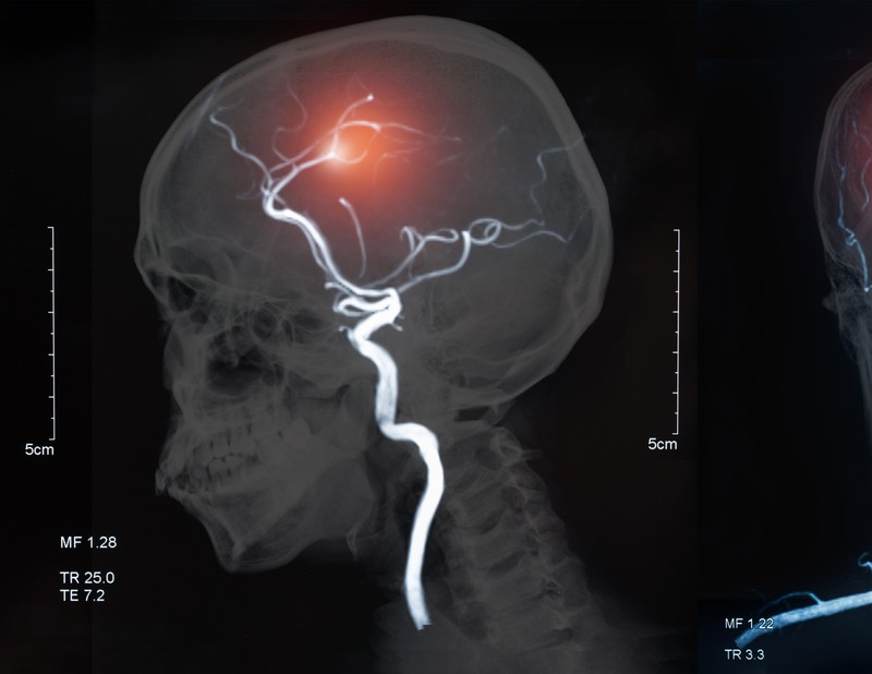 Az ellátás leggyengébb láncszeme: hiányzó rehabilitáció stroke után