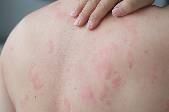 Mennyi idő alatt múlik el a csalánkiütés? című cikk nyitóképe