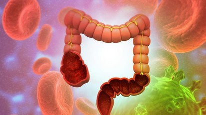 Ennyire komoly betegségeket idézhet elő, ha megbomlik a bélflóránk egyensúlya! című cikk nyitóképe