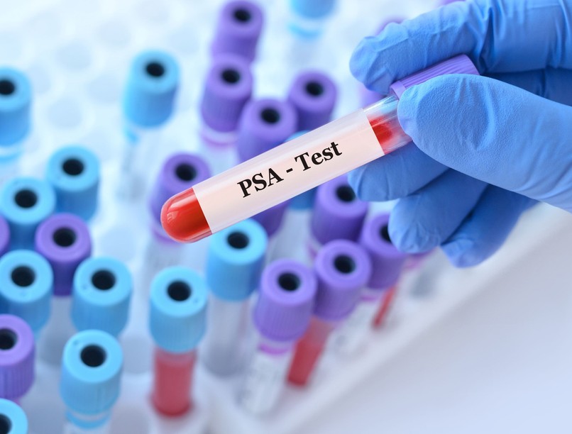 PSA prosztatarák érték mikor magas