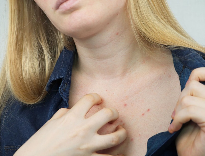 Rühesség ellen mi jó