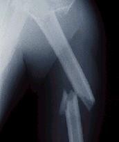 Védd a csontod belülről is!