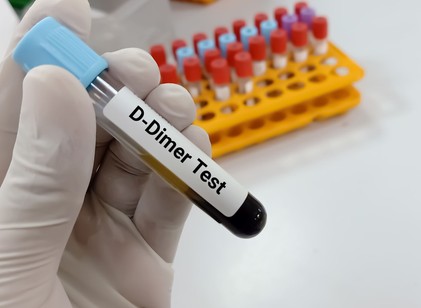 Vérvételi eredmény, ami sokakat megijeszt: mikor kell komolyan venni a magasabb D-dimert? című cikk nyitóképe