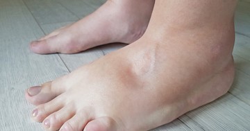  Ödémás lábak: szívbetegség vagy gyógyszer mellékhatás okozza? 