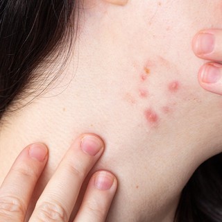 Pattanások a nyakon: nem véletlenül jelennek meg – ezt üzenheti a szervezete című cikk nyitóképe