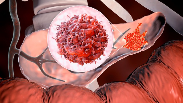 Ezért alakul ki daganatos betegség az esetek nagy részében