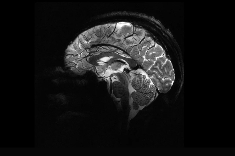Tűpontos agyi felvétel: beüzemelték a világ legerősebb MRI gépét