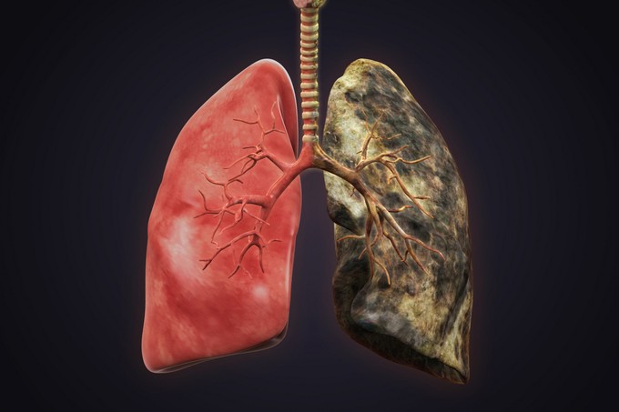 Eltávolították az egyik veséjét és a fél tüdejét annak a nőnek, aki képtelen volt leállni a dohányzással című cikk nyitóképe