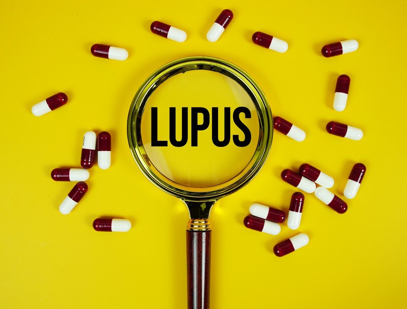 lupus szisztémás lupusz erythematosus SLE