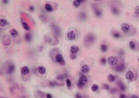 A korszerű terápiáknak köszönhetően az elmúlt években egyre jobban kezelhetővé vált a mielóma multiplex, a csontvelő plazmasejtes daganatos betegsége.