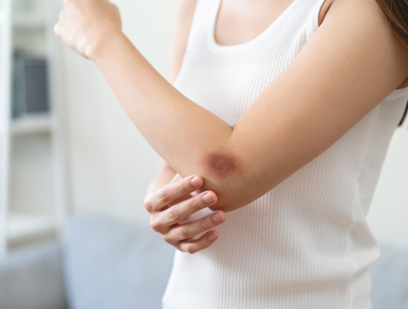 zúzódás kék lila folt bőrön oka sérülés nélkül