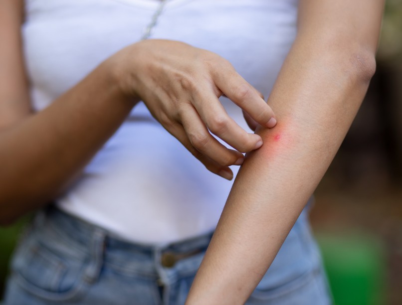 Pókcsípés, légycsípés ágyi poloska csípés milyen