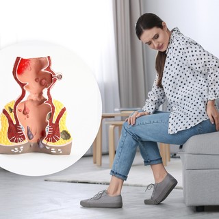 Aranyér: tévhit, hogy csak az idősek betegsége, 20 évesen is kialakulhat című cikk nyitóképe