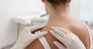 Gyanús anyajegyet talált magán? Ekkor érdemes melanómaszűrésre menni