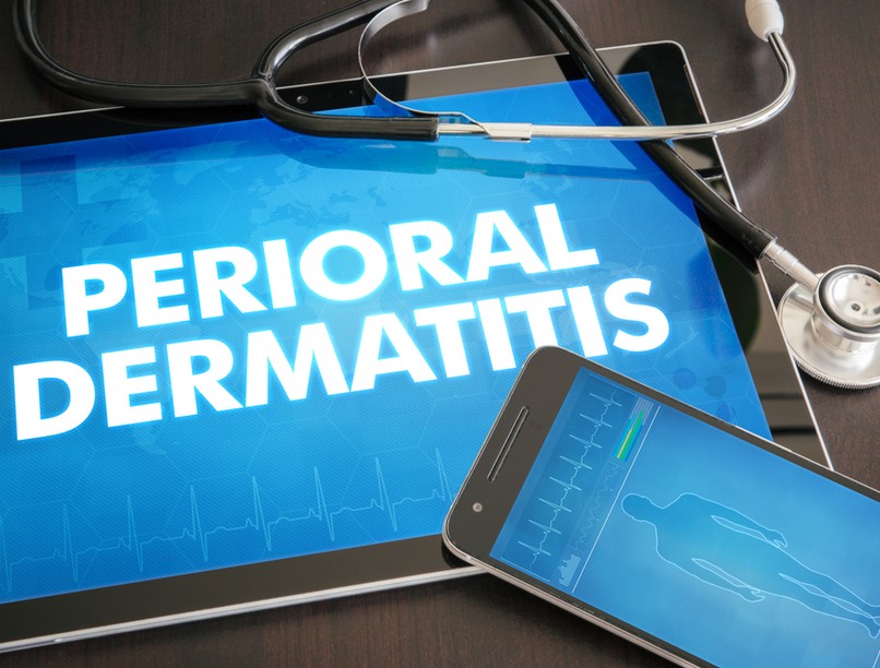 periorális dermatitisz, dermatitisz, tünetei, kezelése, bőrbetegség, viszketés, bőrgyulladás