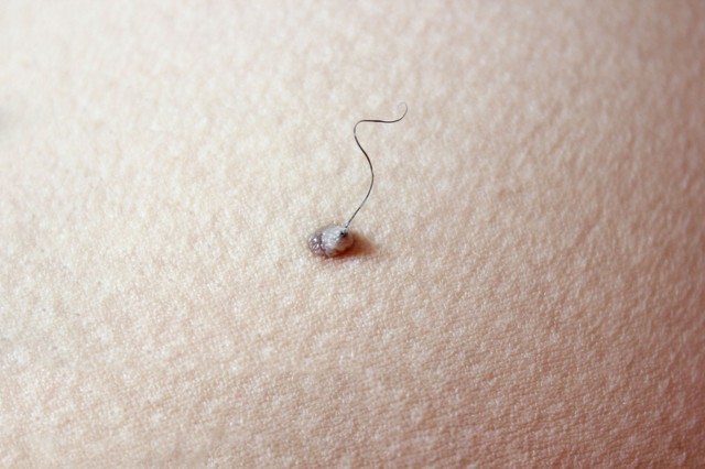 Szőrszál az anyajegyben - itt a válasz arra, hogy rákot okozhat-e az, ha kihúzza belőle