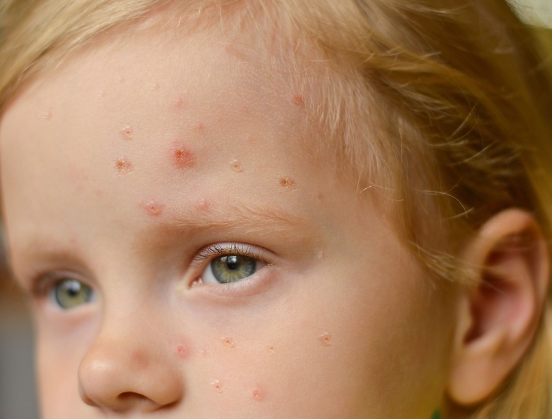 majomhimlő, gyerek, Németország, tünet