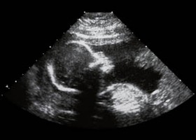 Nyitott gerinc (spina bifida)