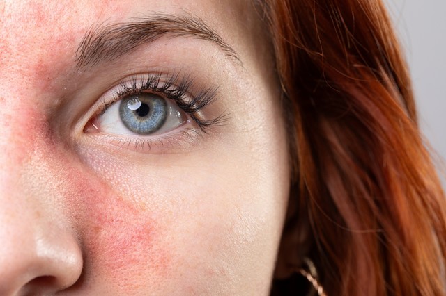 Rosacea, akné: a ChatGPT szinte hibátlanul felismeri a leggyakoribb bőrproblémákat
