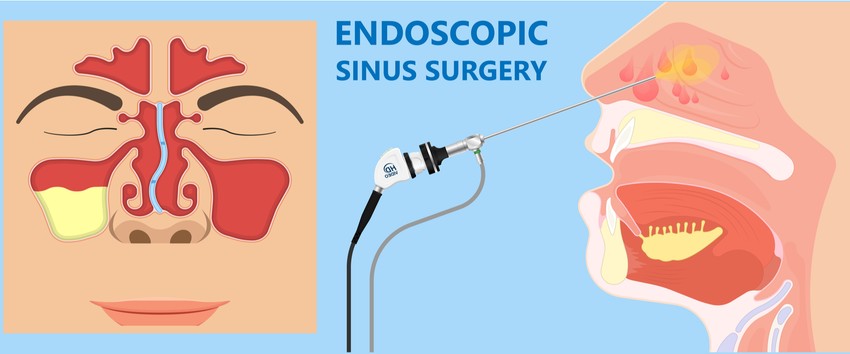 Egyes esetekben a nyálkahártya illetve az érfal fokozottan sérülékennyé válik, így már kisebb behatás eredményeként is kialakulhat az orrvérzés.