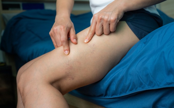 Eltüntethetők-e a lábakról a seprűvénák? Az orvos válaszol című cikk nyitóképe