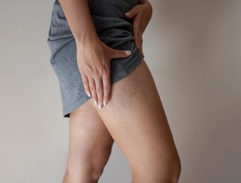 fáj visszér láb ellen kompressziós terápia nyár