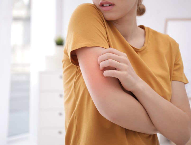 viszkető kiütés, pattanás, ekcéma, napallergia