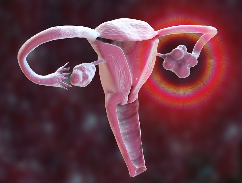 PCOS-szindróma oka tünete hormon