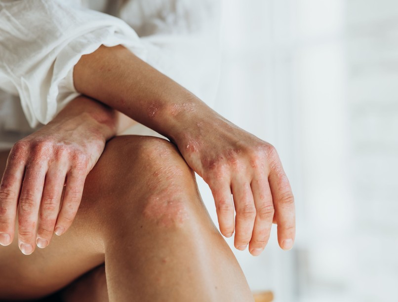 pikkelysömör bőrbetegség tünet