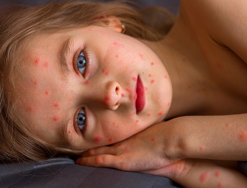 bárányhimlő oka tünet kezelés