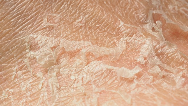 Bőrsérülés (bőrgyulladás, bőrirritáció, sebek) tünetei, vizsgálata és kezelése