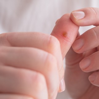 Szemölcs: tünetek, vizsgálatok és kezelési lehetőségek című cikk nyitóképe