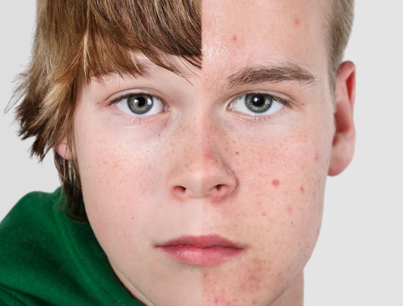 alacsony tesztoszteronszint, hormonzavar, tesztoszteron, nemi érés, pubertás