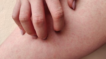 A csalánkiütést egtöbbször valamilyen allergén (étel, gyógyszer) vagy fertőzés vált ki, de stressz is okozhatja.