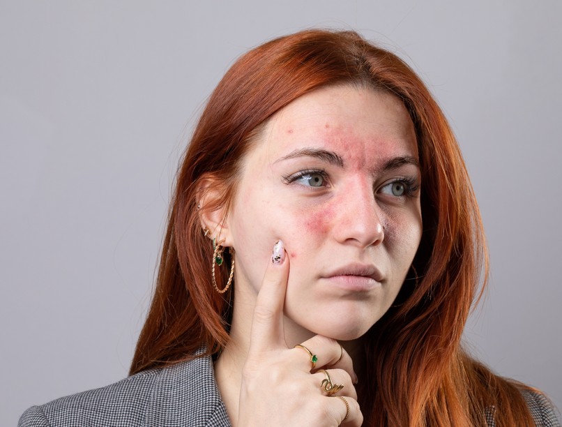 hogyan alakul ki ekcéma étrend életmód viszketés bőr