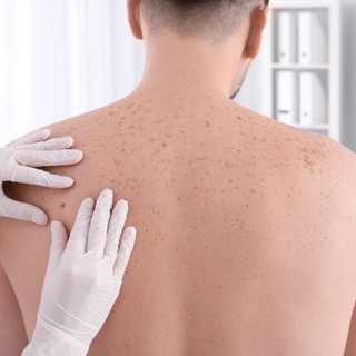 Mennyire veszélyes az anyajegy eltávolítása? Mi az igazság és mi a rémhír? című cikk nyitóképe