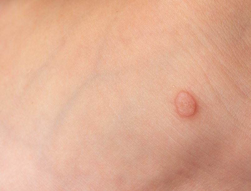 szemölcs fagyasztás kezelése