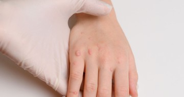  Nem csak esztétikai gond: így kezelhetők biztonságosan a gyermekkori szemölcsök 