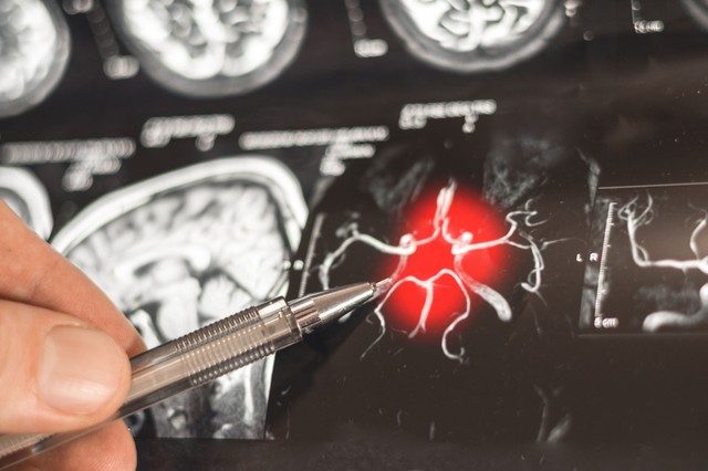 Forradalmi fordulat az Alzheimer-kutatásban: a K-vitamin új változata képes újjáépíteni az agysejteket