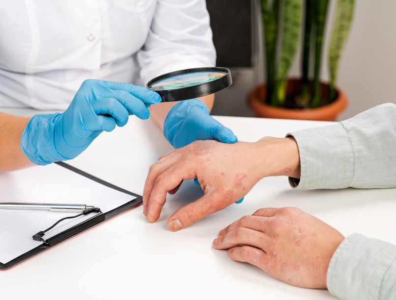 ekcéma, száraz bőr, visketés, stressz