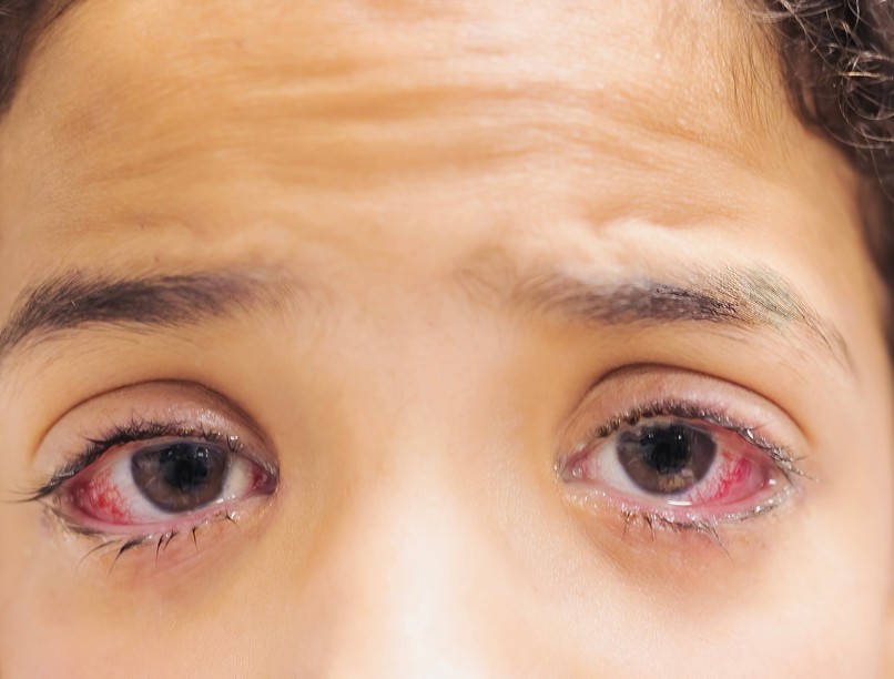 kötőhártya gyulladás Nem múló