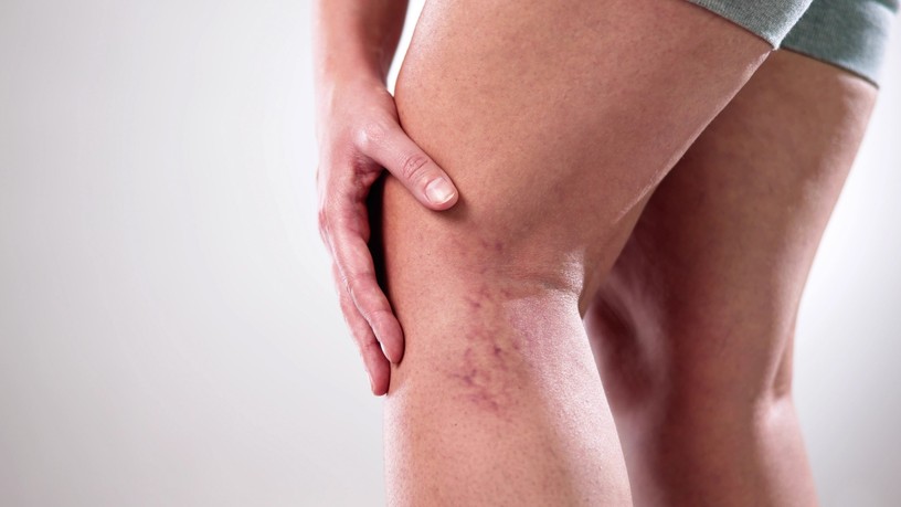 fekély, visszértágulat kezelés