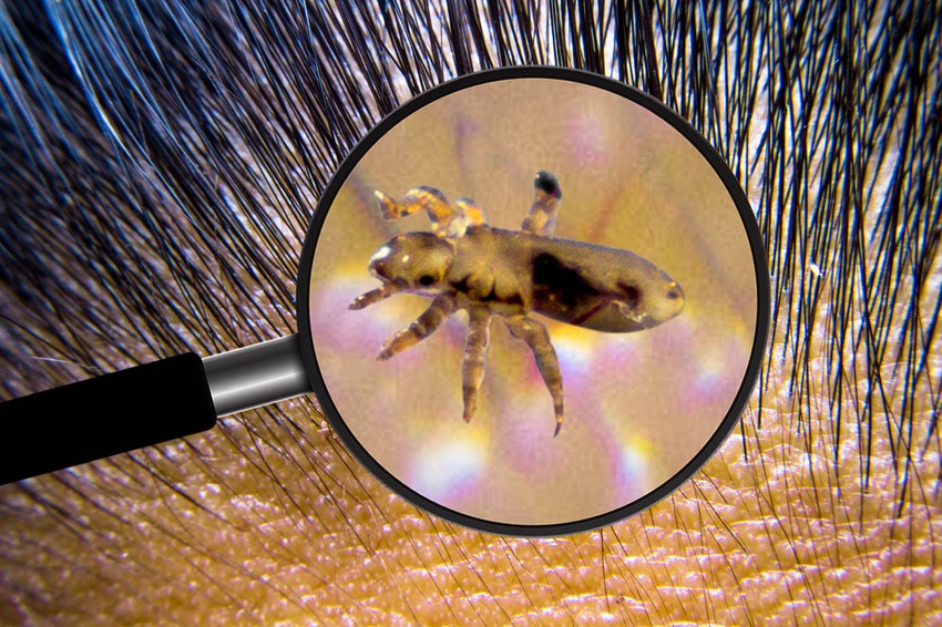 Emberen háromféle tetű fordul elő: fej-, ruha- és lapostetű. Az első kettő egy faj két változata, külön fajt csak a lapostetű alkot. 