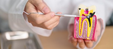 A fogszuvasodás oka, tünetei és kezelési lehetőségei