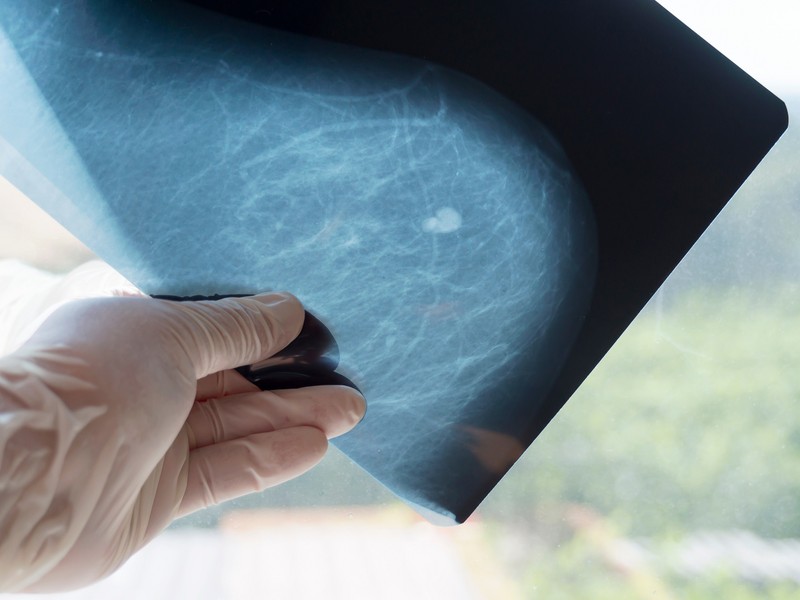 Emlőciszta vagy tumor okozza a csomót a mellben? Ez a vizsgálat segít tisztázni