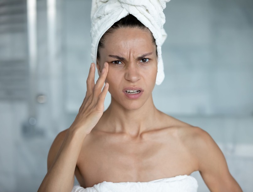 bőratka, arcbőr, pattanások, rozacea, hajhullás