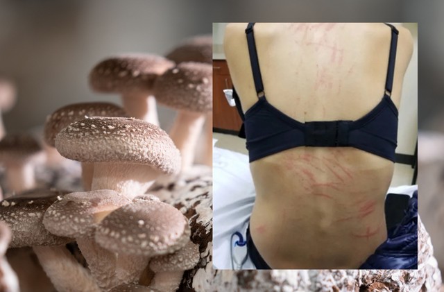 Mintha megkorbácsolták volna: furcsa kiütések jelentek meg egy nő hátán miután shiitake gombát evett