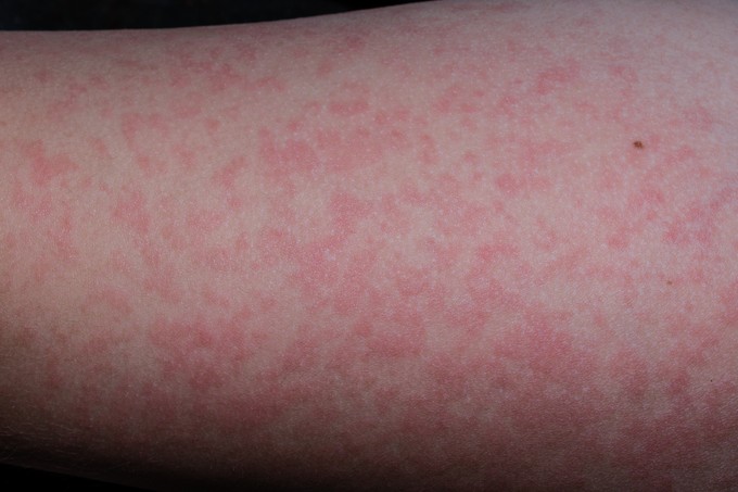 Lepkehimlő tünetei gyerekeknél című cikk nyitóképe