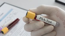 PSA-vizsgálatra készül? A vizsgálat előtti napok eseményei is befolyásolhatják az eredményt című cikk nyitóképe