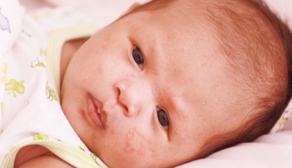 A legveszélyeztetettebbek azok, akik még nem kaptak kanyaró elleni oltást